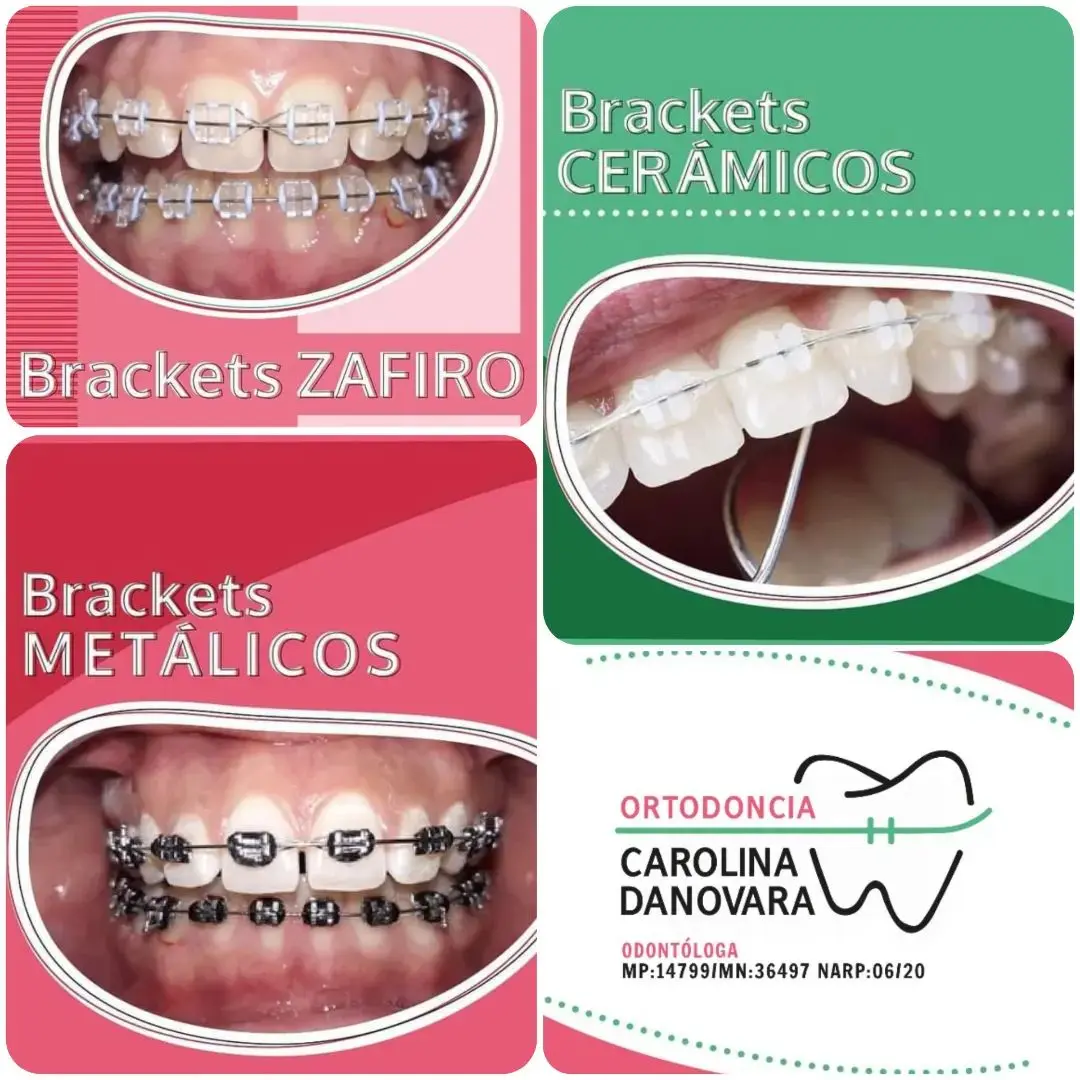 Brackets Autoligantes