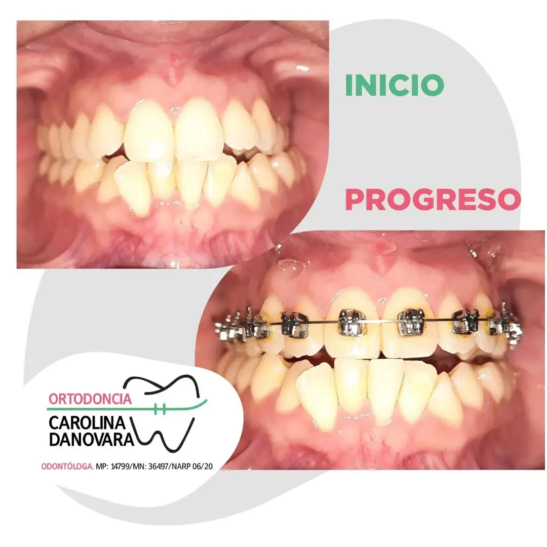 Caso antes y después con brackets - Adulto
