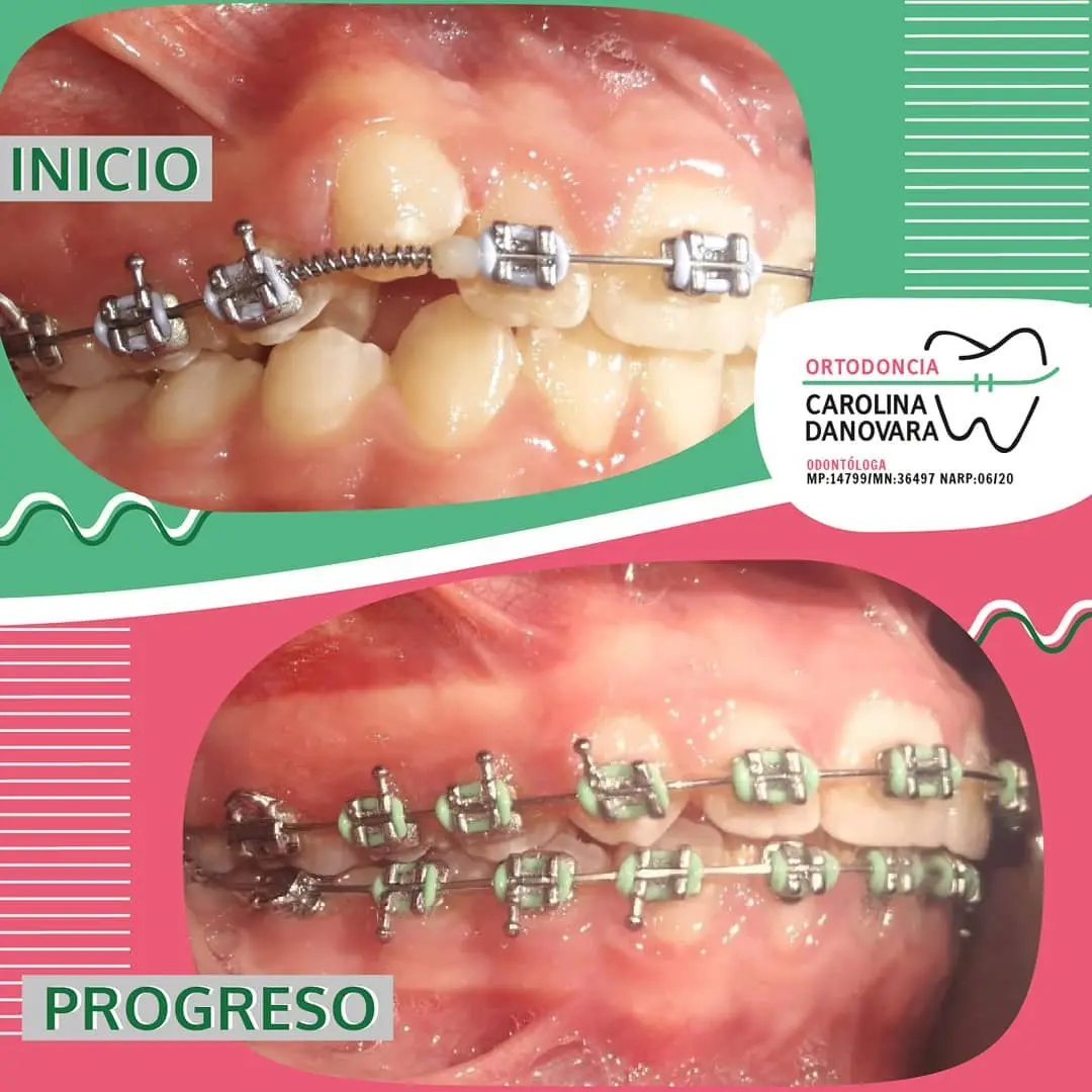Caso antes y después con brackets - Adulto